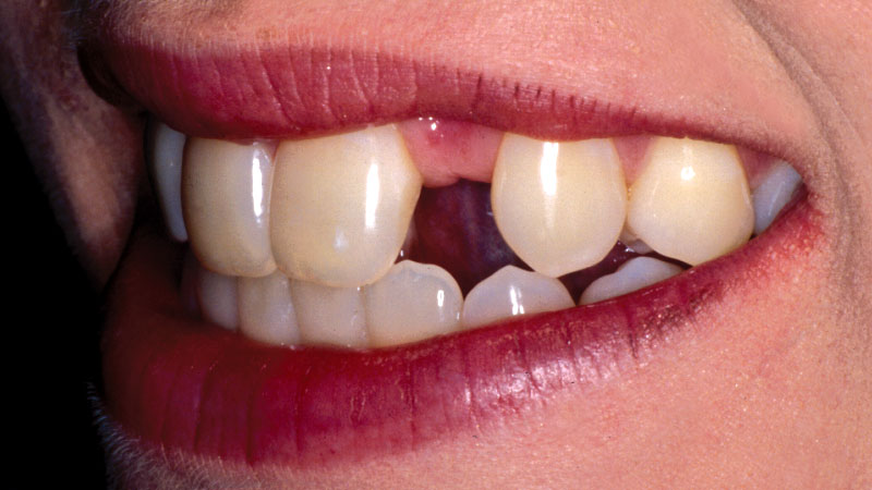 Clinical Study 1 Before