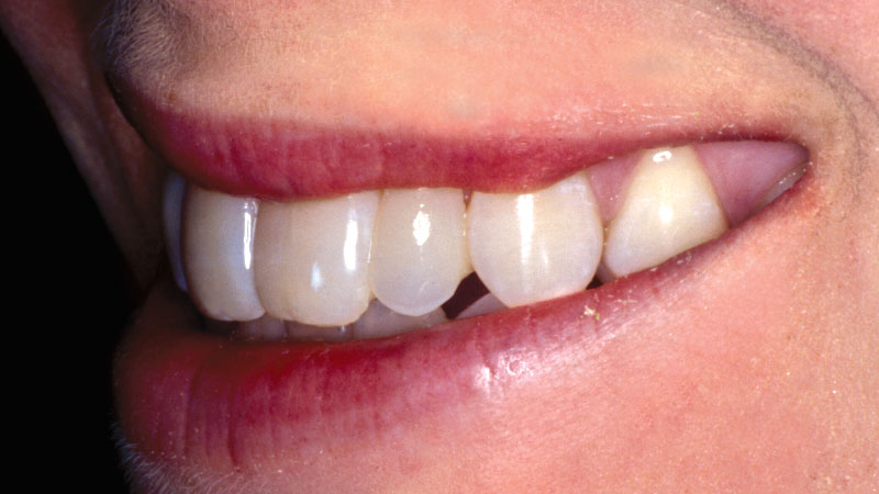 Clinical Study 1 After