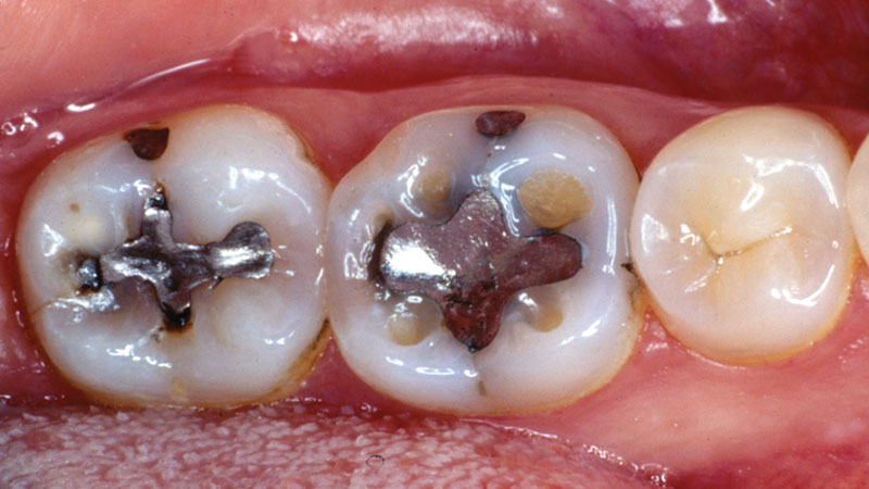Case 2 Before - Recurrent decay