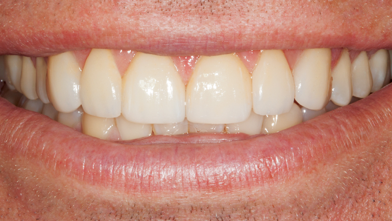 Clinical study- case 2 after