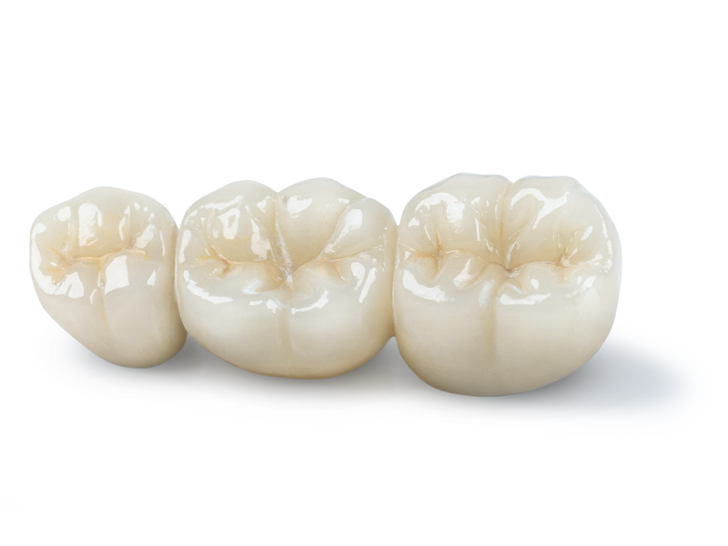 Obsidian Fused to Metal 3-unit bridge