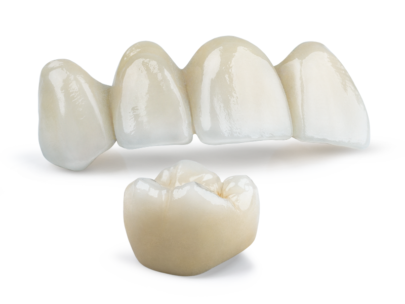 Obsidian Fused to Metal single unit posterior and 4-unit anterior bridge
