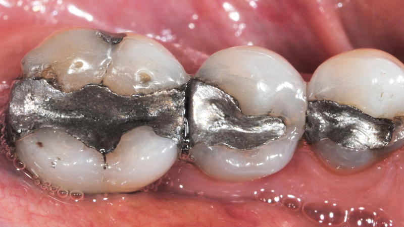 before photo of patient with amalgam molar