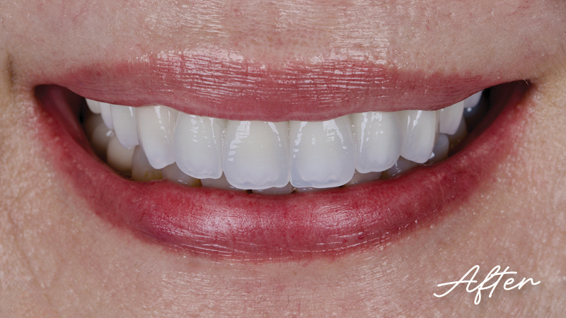 Clinical study- case 1 after