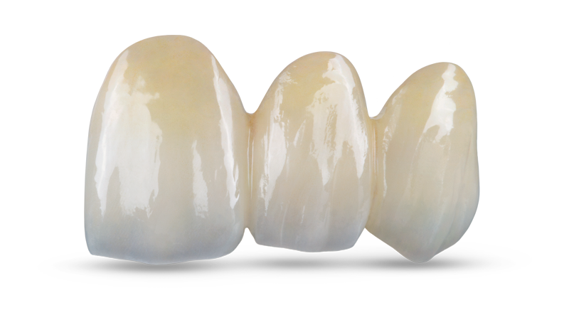 BruxZir Esthetic 3-unit anterior bridge