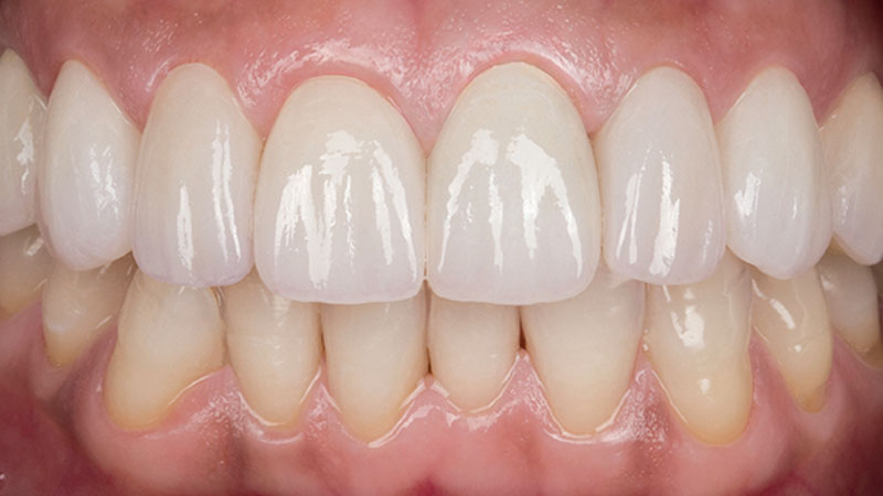 Clinical study- case 1 after