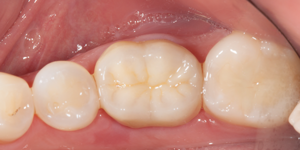 Clinical study- case 6 after