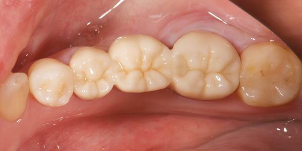 Clinical study- case 4 after