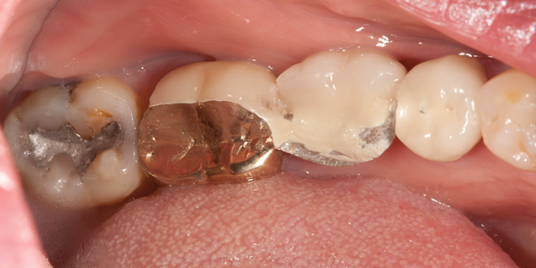 Clinical study- case 5 before