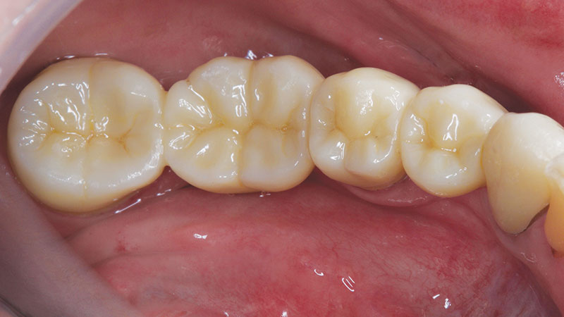 Clinical study- case 1 after