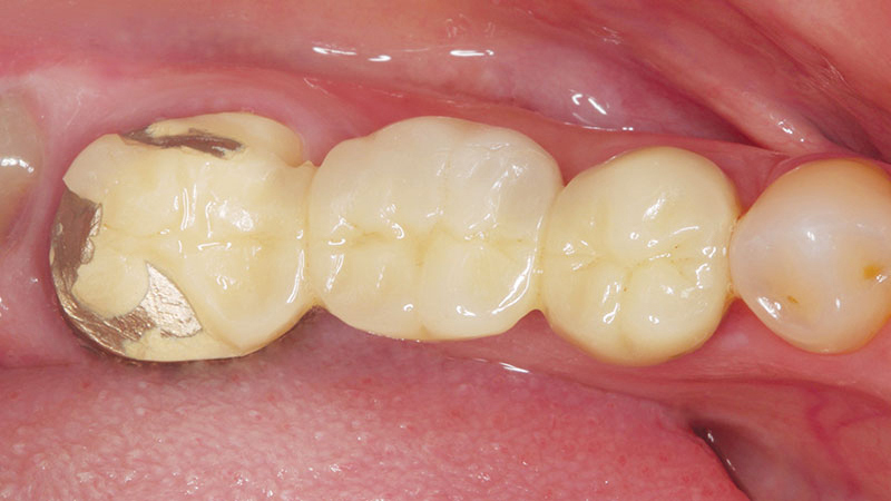 Clinical study- case 2 before