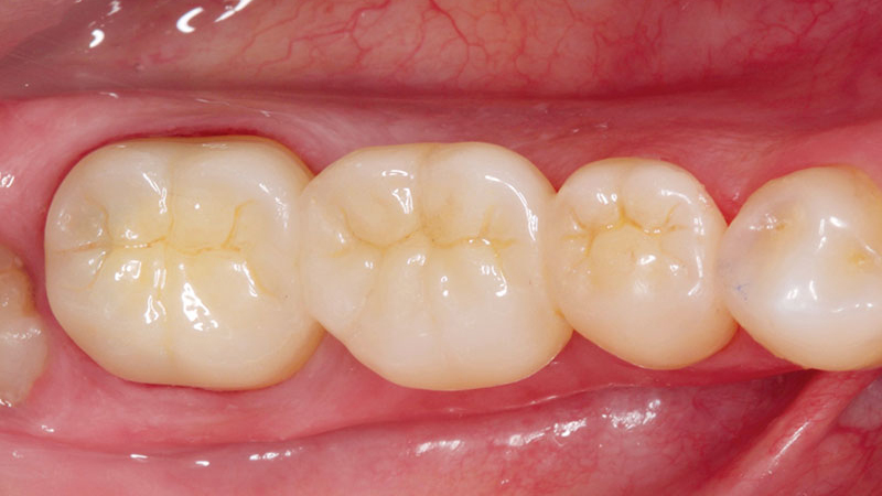 Clinical study- case 2 after