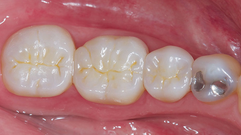 Clinical study- case 3 after