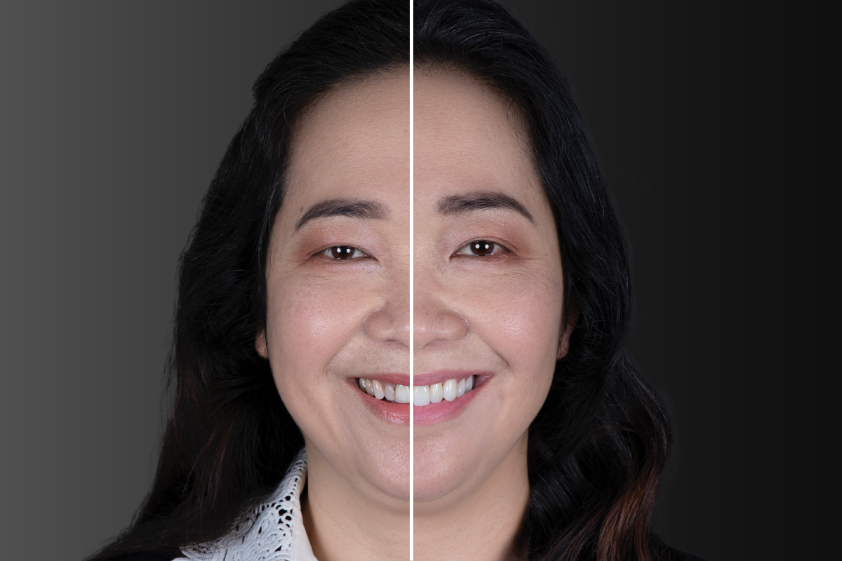 Hoa | Teeth Restored: #4-13 | Restoration Types: Veneers, Crowns