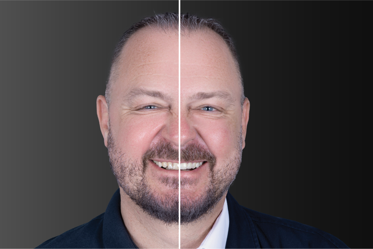 Mark | Teeth Restored: #6-11 | Restoration Types: Veneers, Crowns