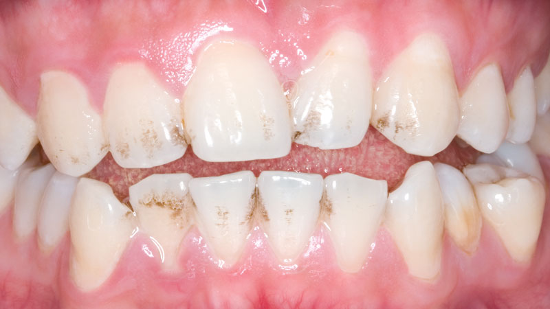 Clinical Study: 31-year-old male born without his left maxillary central incisor