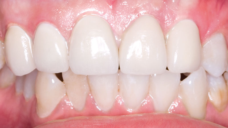 Clinical Study: Bilayered Clinical Zirconia crown placed on tooth #10 was shaped to look like tooth #9