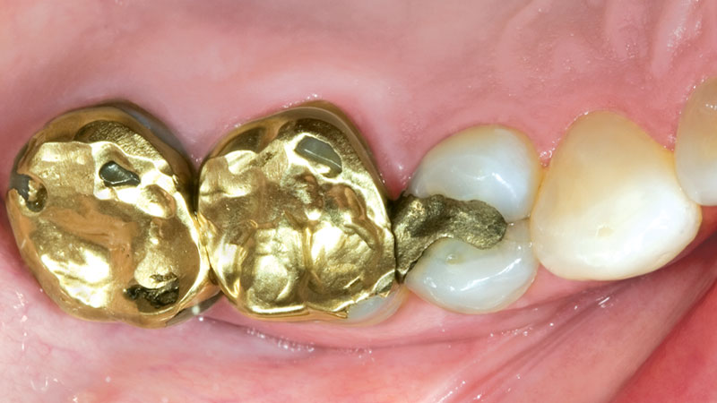 Clinical Study: 47-year-old female tooth #4 has a vertical fracture through the mesial ridge and requires a full-coverage restoration