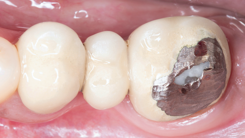 Long-Lasting BruxZir Bridges BEFORE