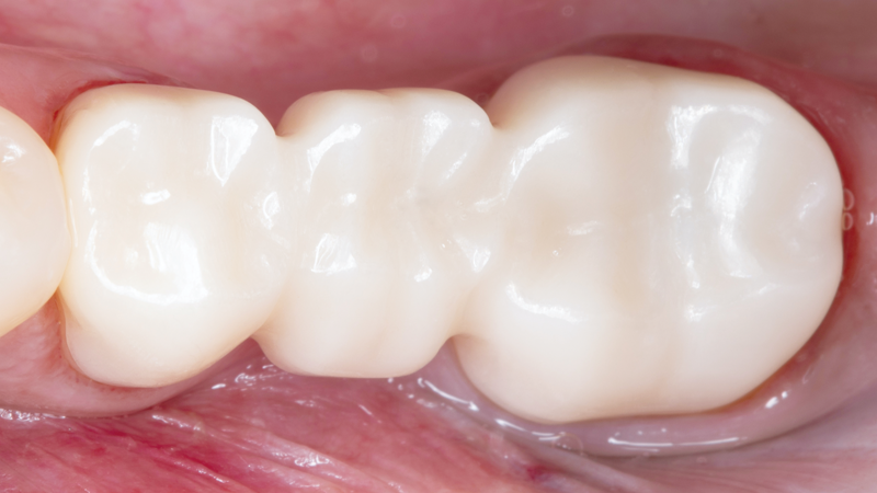 BruxZir NOW Bridge Block After