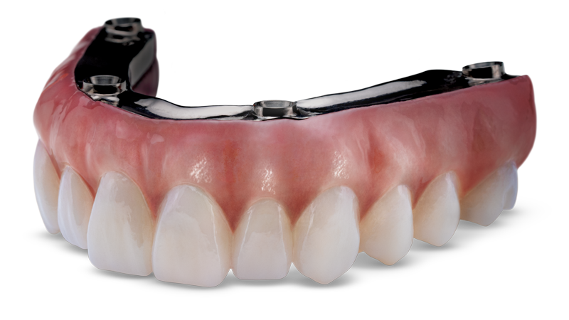 BruxZir® Esthetic Implant Prosthesis