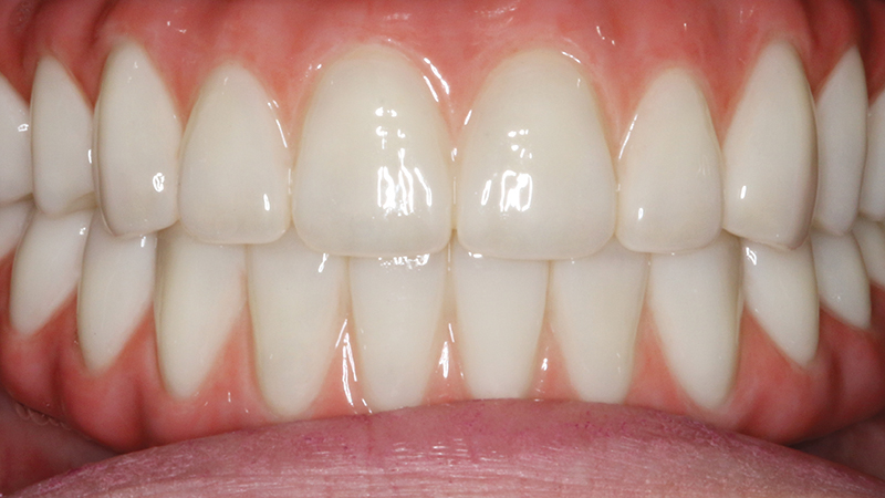 After image of patient with BruxZir Esthetic Prosthesis