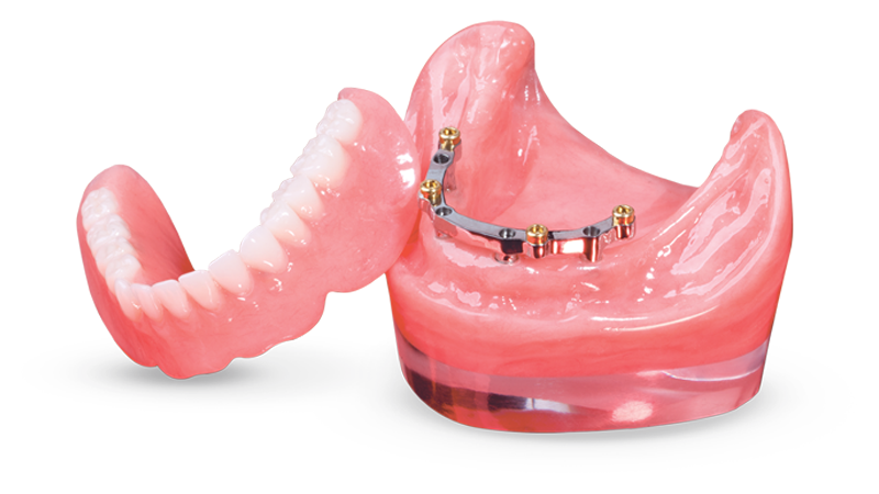 Locator® CAD/CAM-Milled Bar Overdenture