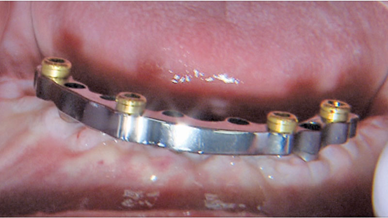titanium bar with Locator abutments