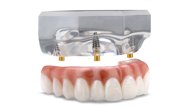 Fixed Locator Prosthesis sample