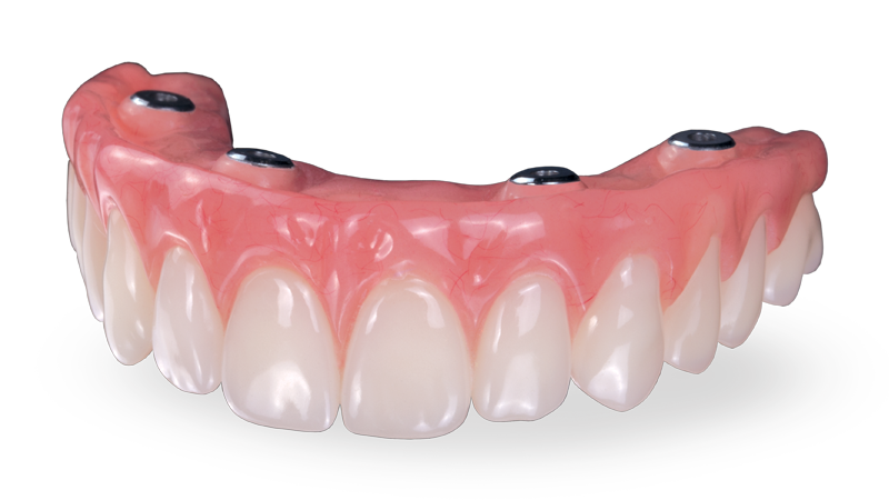 Screw-Retained Hybrid Denture Signature Image