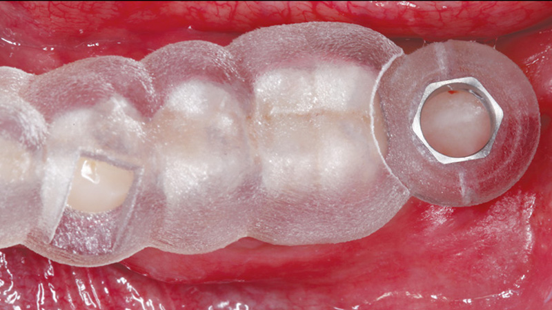 Digital treatment planning software was used to determine implant position at the edentulous space