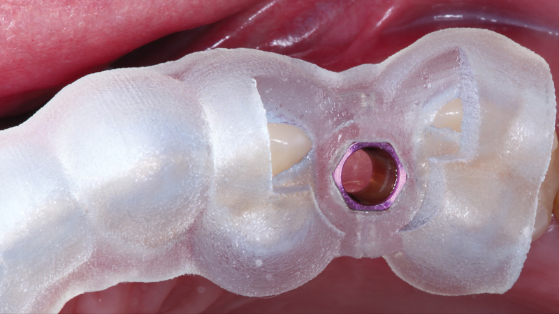 Surgical guide used on location