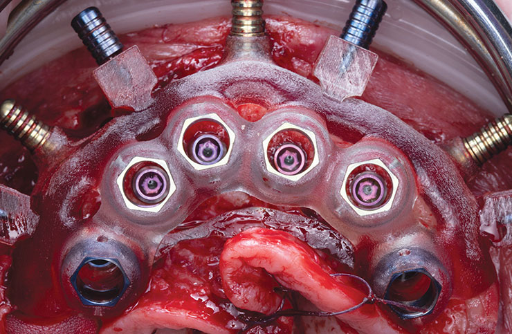 osteotomies using multi-level surgical guide