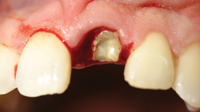 Patient with fractured maxillary