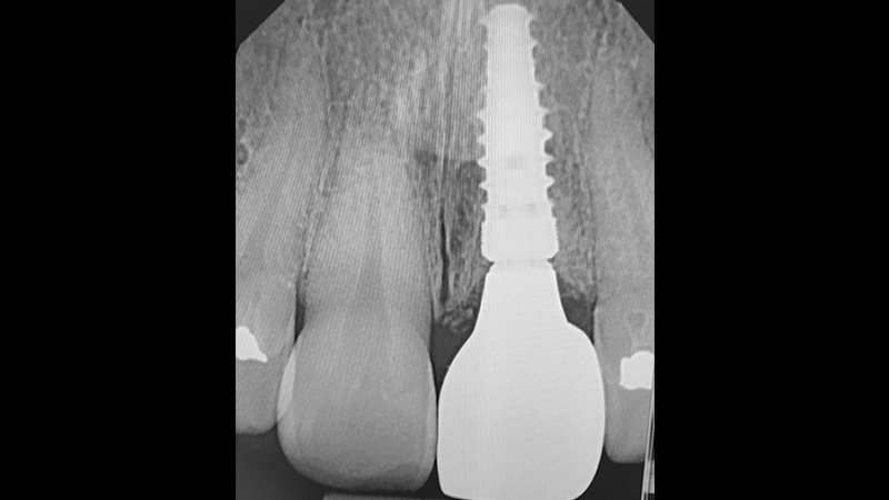 Four months recovery with a 4.3 mm x 13 mm Hahn Tapered Implant