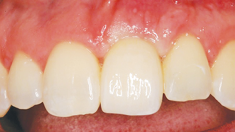 After image of patient's recovered teeth