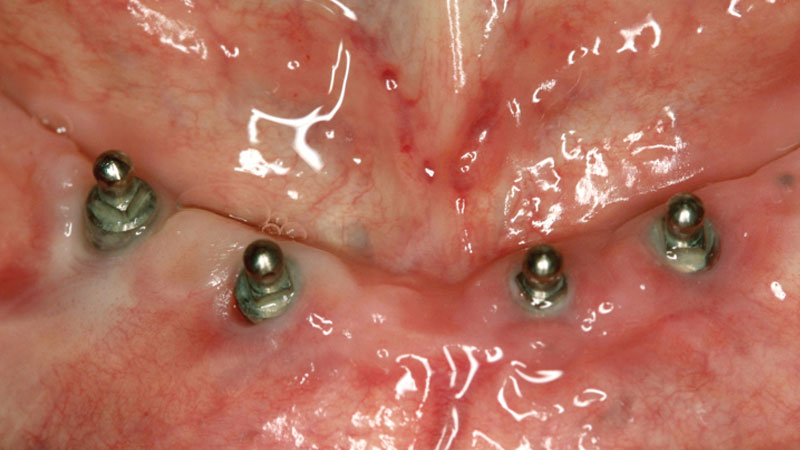 Three months of soft tissue healed around small-diameter implants