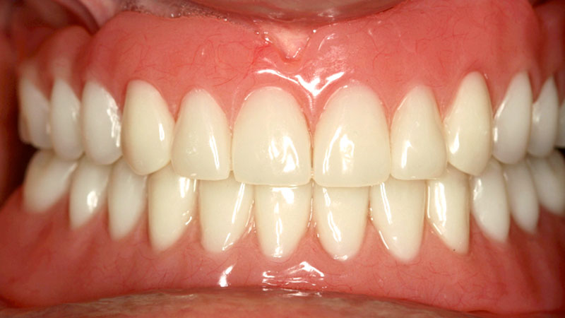 Mini implants restored functionality for patient