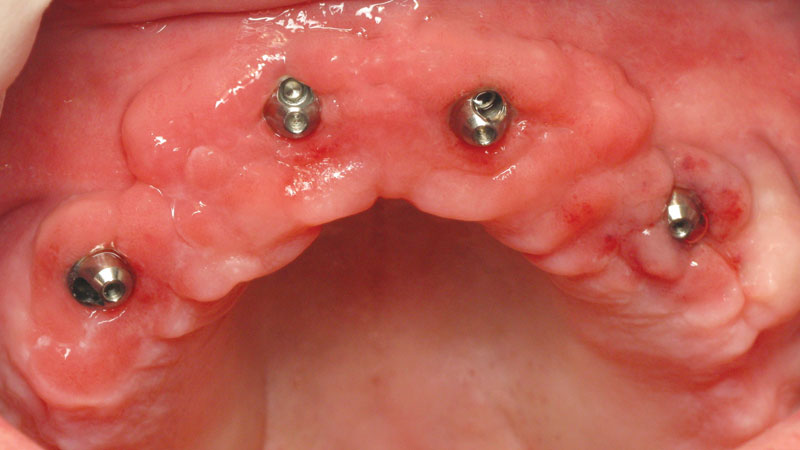 Multi-Abuttment around the arch image