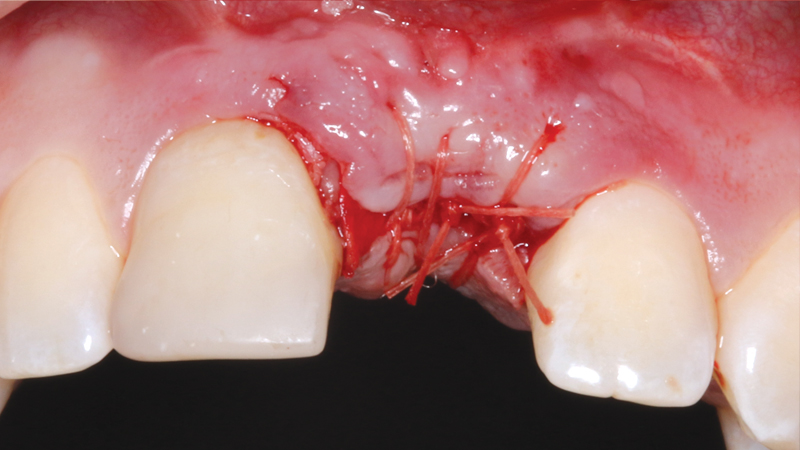 Wound after applying collagen membrane and allograft blend