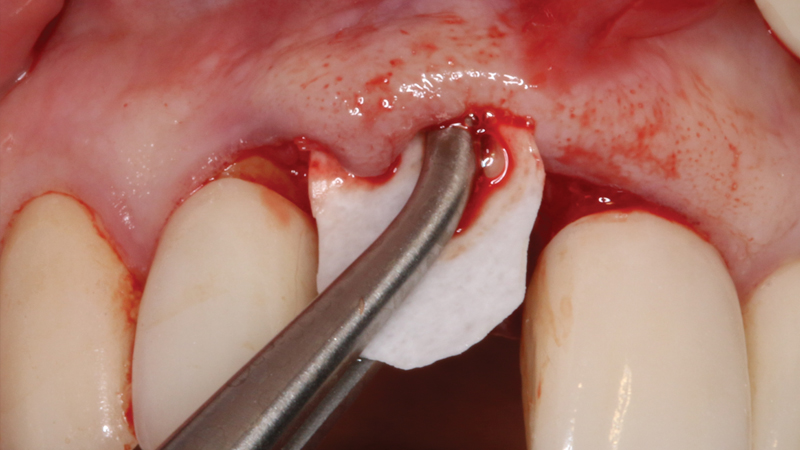 Hahn™ Tapered Implant, Newport Biologics Mineralized Cortico/Cancellous Allograft Blend is dispensed into a sterile dappen dish and hydrated