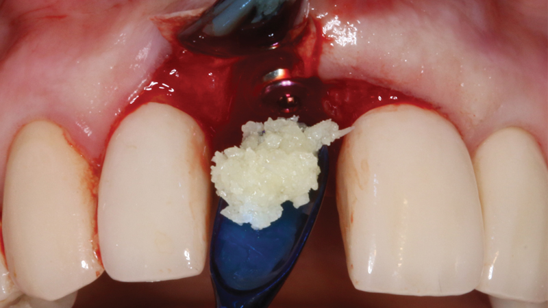 Newport Surgical Resorbable Collagen Membrane is trimmed and positioned to extend 2 mm beyond the defect on the facial aspect