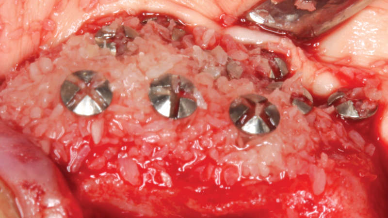 Newport Biologics Mineralized Cortico/Cancellous Allograft Blend possesses the optimal features of cortical and cancellous bone, with particle sizes