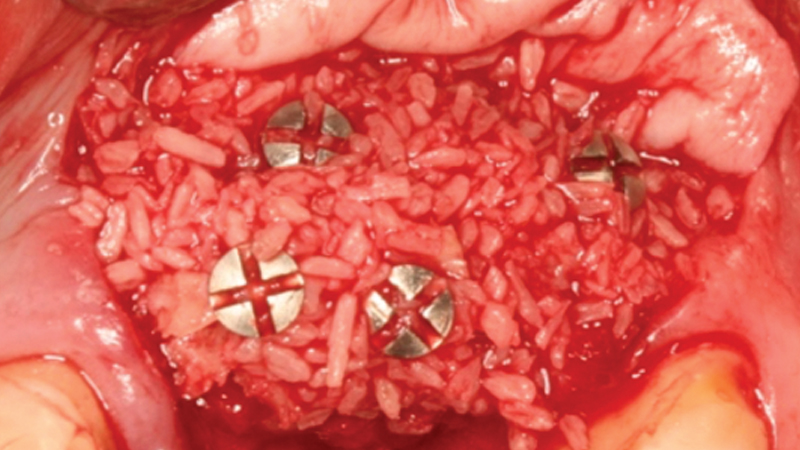 particle size is approximately 250–1,000 microns