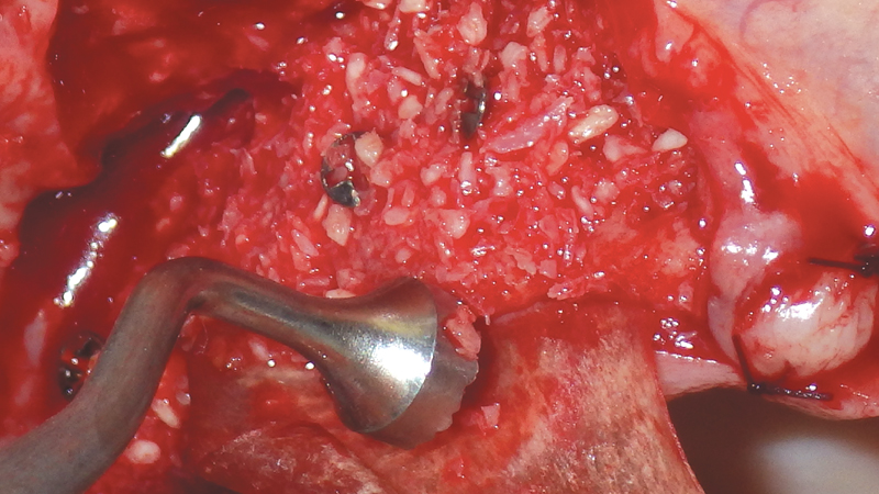 clinical GBR and lateral ridge augmentation procedures with the use of mineralized cortico/cancellous bone