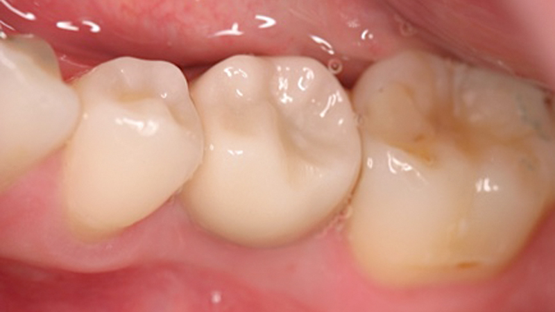 Final BruxZir Full-Strength crown was cemented over the custom abutment