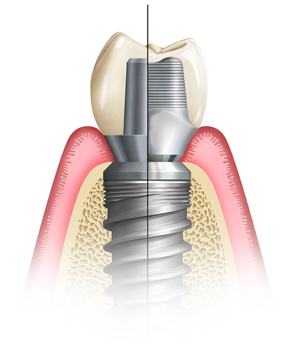 Custom Abutment vs. Stock Abutment