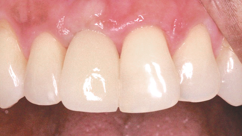 after photo of final BruxZir Zirconia crown delivered