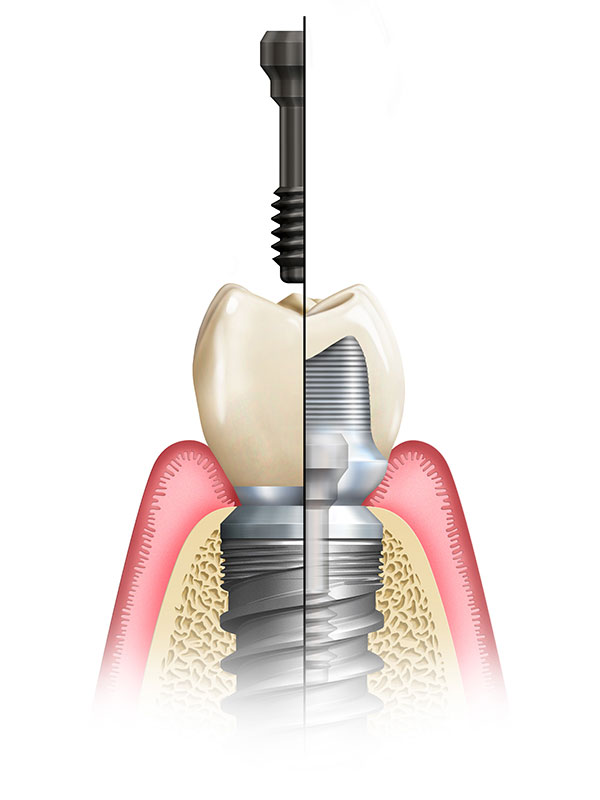 Screw-Retained Crown vs. Custom Abutment