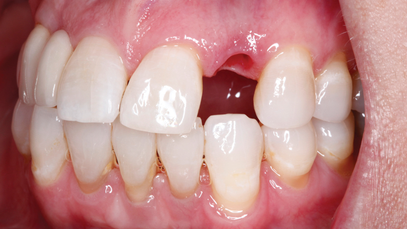 Before photo of patient with extracted tooth #10